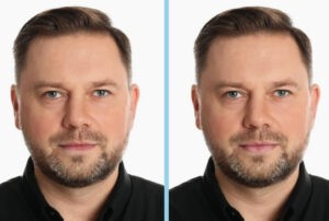 dermal fillers men before and after