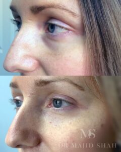 Before and after tear trough treatment