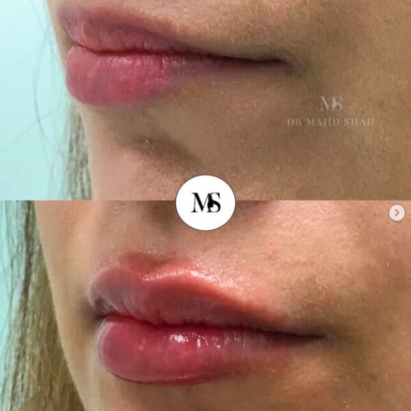 1ml lip filler before & after