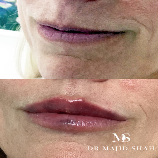 1ml lip treatment before & after