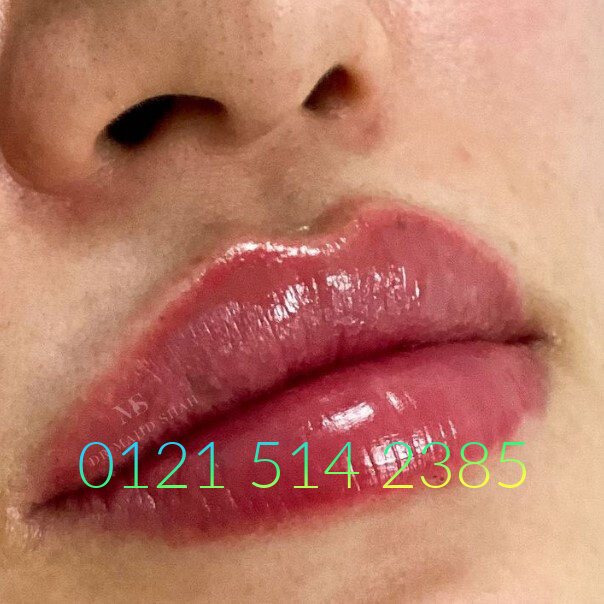 0.5ml lip enhancement before & after