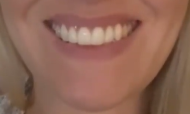 Gummy smile after Botox treatment, Dr Majid Shah, Birmingham