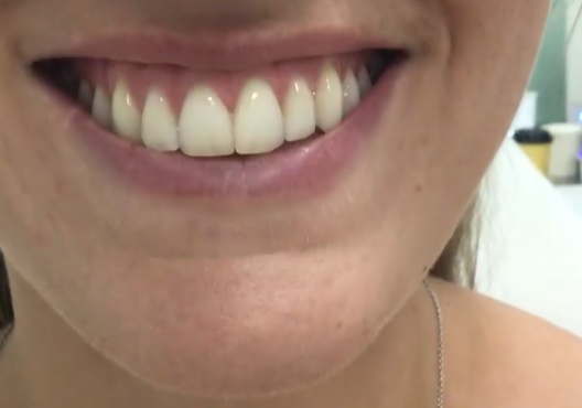 Gummy smile before Botox treatment